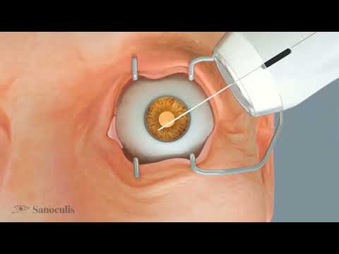 Sanoculis erhält CE Mark für MINT®-Produkt zur Behandlung des Grünen Stars (Glaukom)